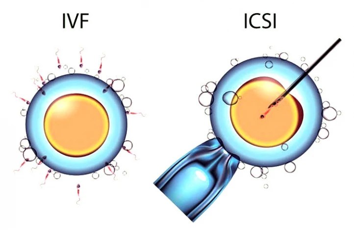 روش میکرواینجکشن (ICSI) چیست و چه تفاوتی با IVF دارد؟