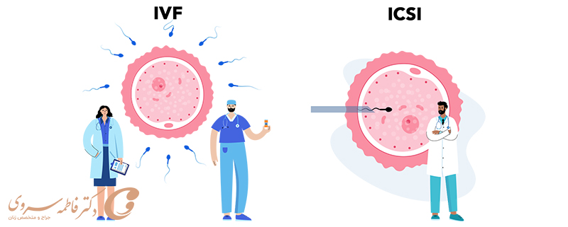 روش میکرواینجکشن (ICSI) چیست و چه تفاوتی با IVF دارد؟