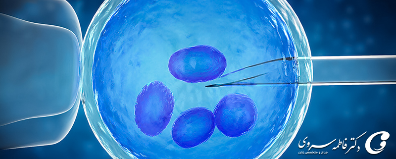 تعیین جنسیت به روش IUI