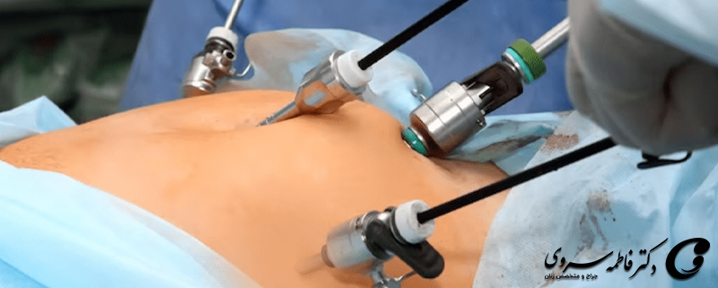 جراحی لاپاراسکوپی چیست و چه کاربردهایی دارد؟