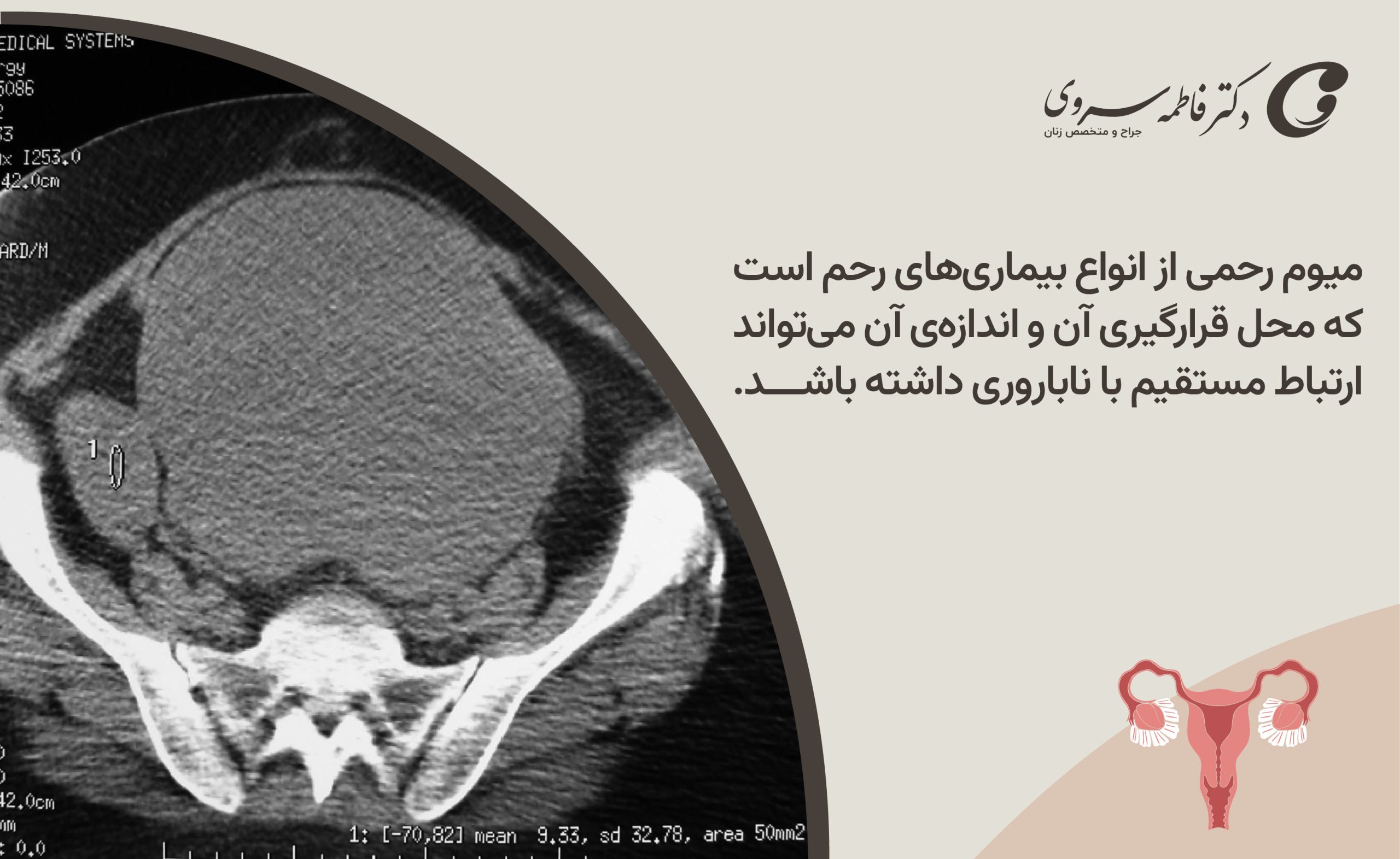 میوم رحم