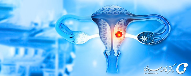 میوم رحم (فیبروم رحم) چیست و چگونه درمان می‌شود؟