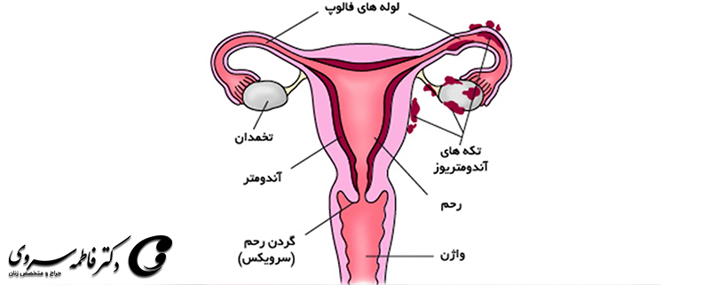 آندومتریوز – اندومتریوز ( علائم – تشخیص – درمان)