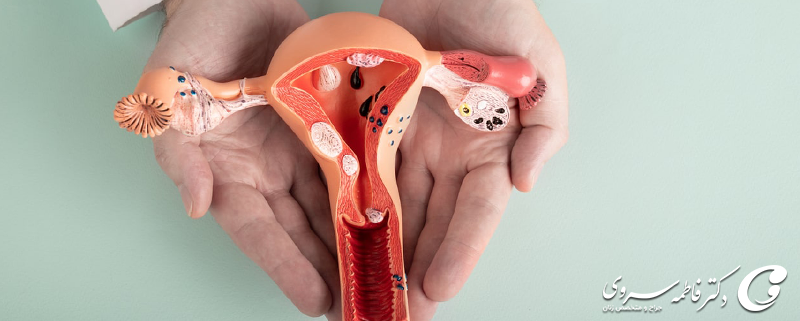 کیست اندومتریوز