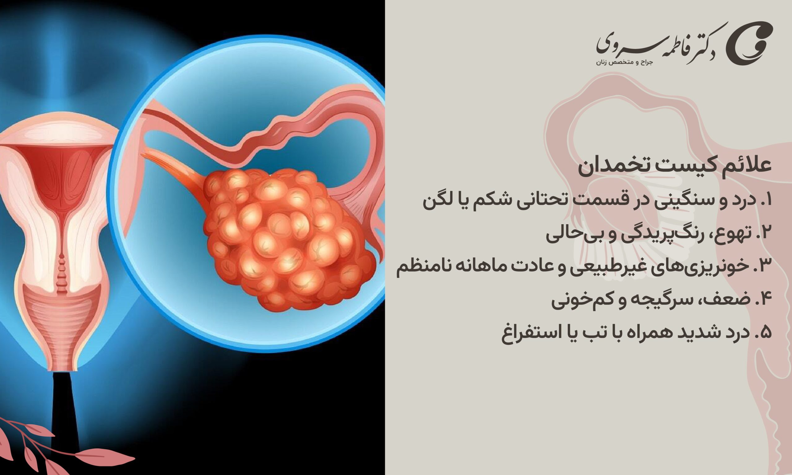 علائم کیست تخمدان 