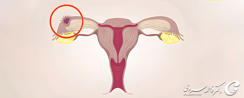 حاملگی خارج رحم