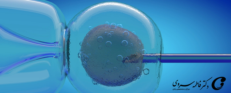 روش میکرواینجکشن (ICSI) چیست و چه تفاوتی با IVF دارد؟