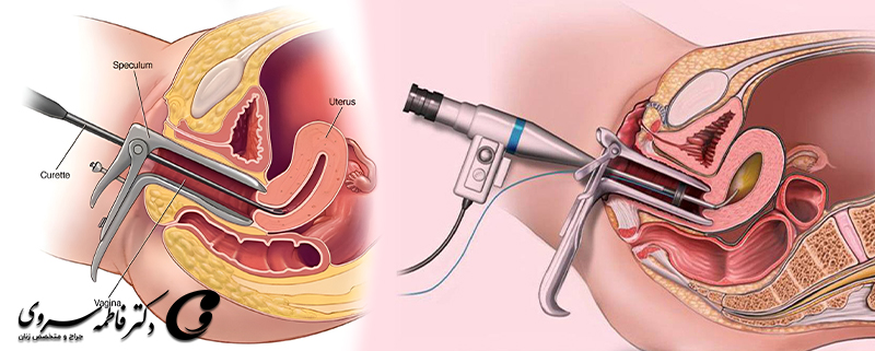 کورتاژ و هیستروسکوپی