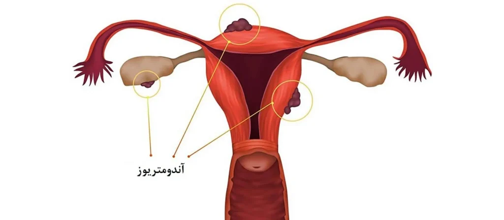 مزایا و محدودیت‌های کورتاژ در بررسی مشکلات رحم